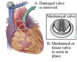 Tick, tick, tick, goes the heart valve.